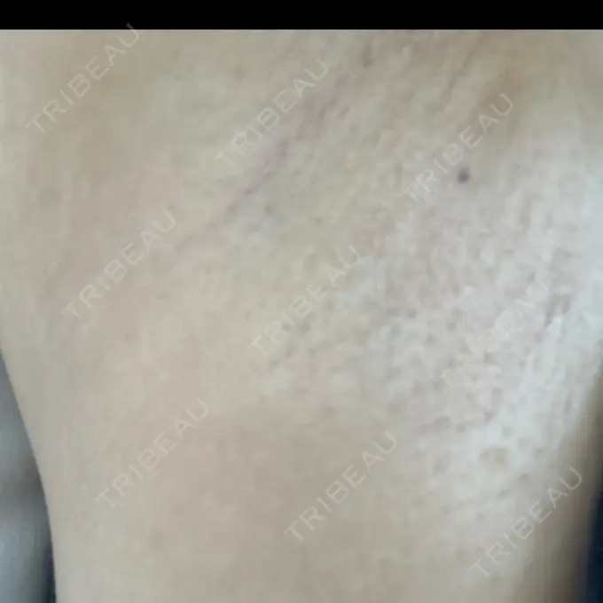 医療脱毛（ワキ） 湘南美容クリニック 自由が丘院 AFTER メイン用