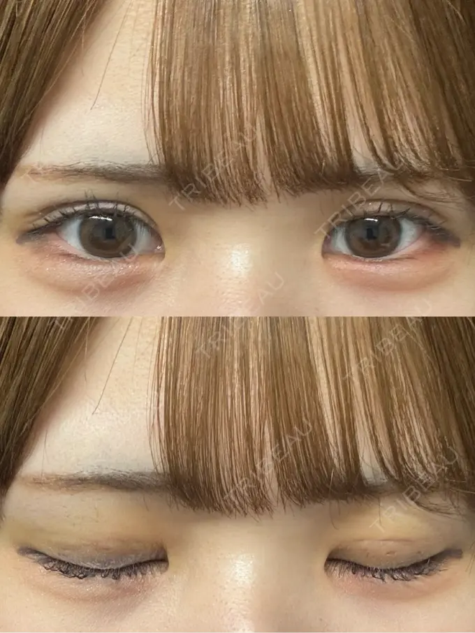 二重埋没 / 上まぶたの脂肪取り THE FIRST CLINIC 多摩センター院 DAY 4 メイン用