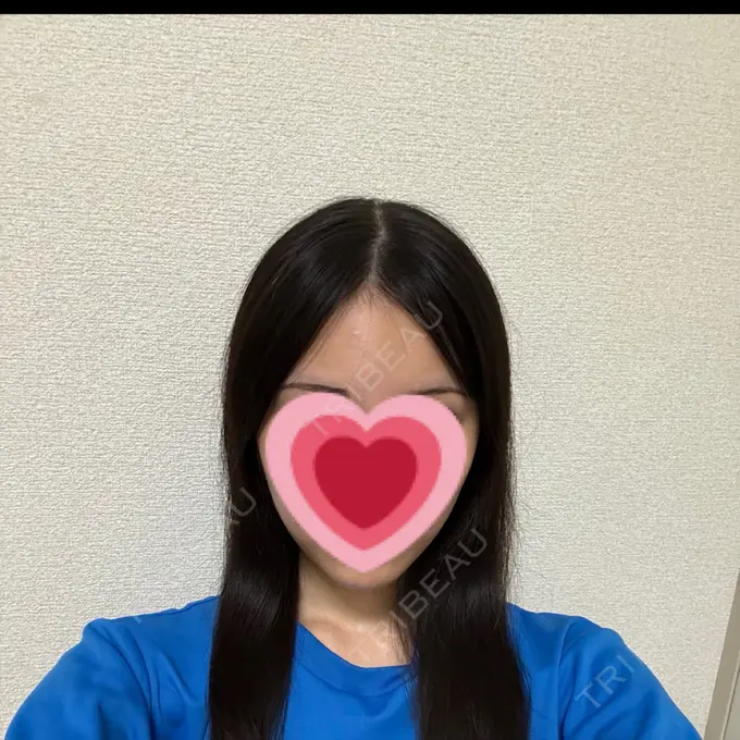 糸リフト / 脂肪吸引（顔） / ボトックス（エラ・小顔） RIVER CLINIC（リバークリニック） DAY 3 メイン用