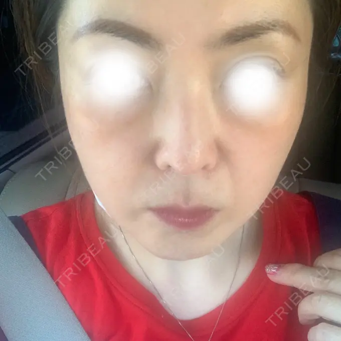 糸リフト / ヒアルロン酸注入（頬） ネビュラクリニック 京都院 AFTER メイン用