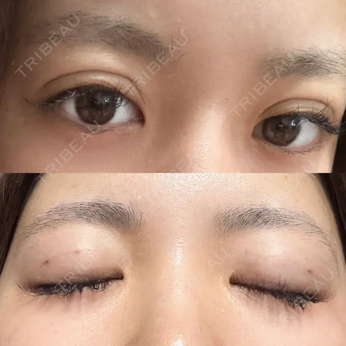 二重埋没 アリエル美容クリニック 郡山院 DAY 0 メイン用