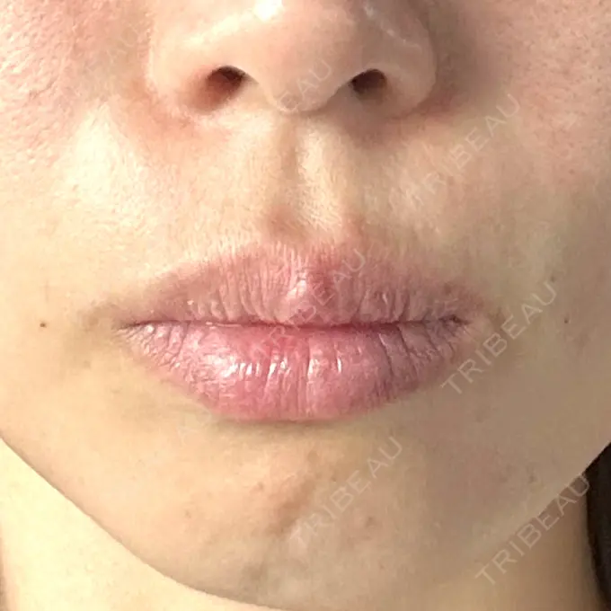 糸リフト / クマ治療 / ボトックス（あご） / 肌ヒアルロン酸注入（たるみ・シワ改善） / ボトックス（口角） / 脂肪溶解注射（二の腕） / ボトックス（肩） / ボトックス（眉間） / ボトックス（額） TCB東京中央美容外科 岐阜院 AFTER メイン用