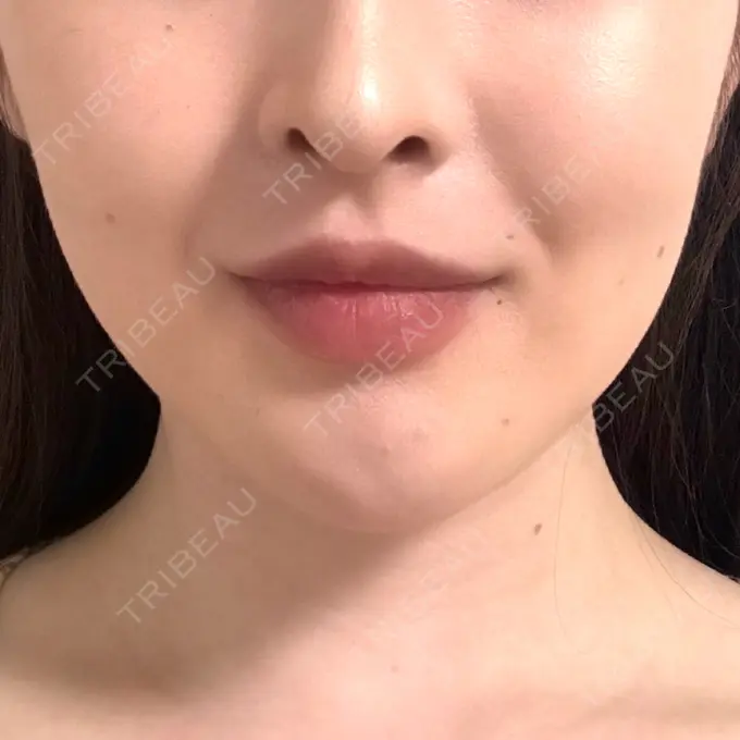 ボトックス（エラ・小顔） BiBiクリニック AFTER メイン用