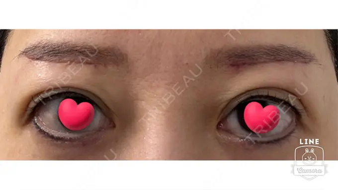 眉下切開 ルーチェクリニック 銀座院 AFTER メイン用