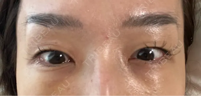 クマ治療 セオリークリニック DAY 3 メイン用