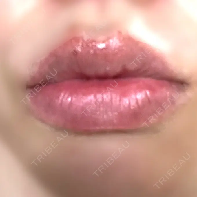 ヒアルロン酸注入（唇） ルラ美容クリニック 名古屋栄院 / ルラスキンクリニック 名古屋栄院 DAY 8 メイン用