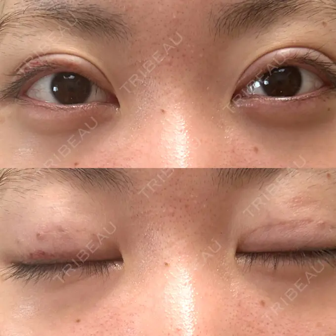 二重埋没 東京ココセランクリニック DAY 16 メイン用