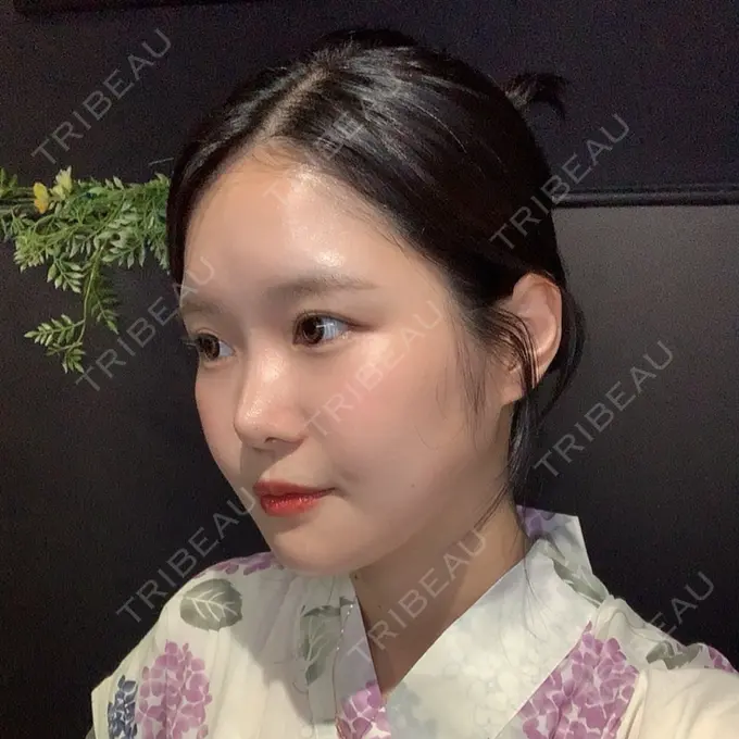 骨切り（あご） / 骨削り（エラ） / 骨削り（頬） id（アイディ）美容外科 DAY 209 メイン用