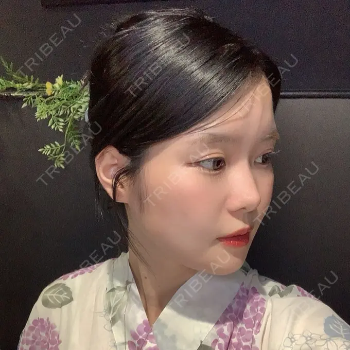 骨切り（あご） / 骨削り（エラ） / 骨削り（頬） id（アイディ）美容外科 DAY 209 メイン用