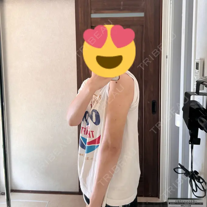 脂肪吸引（二の腕） アムルーズ美容外科クリニック 横浜院 DAY 17 メイン用