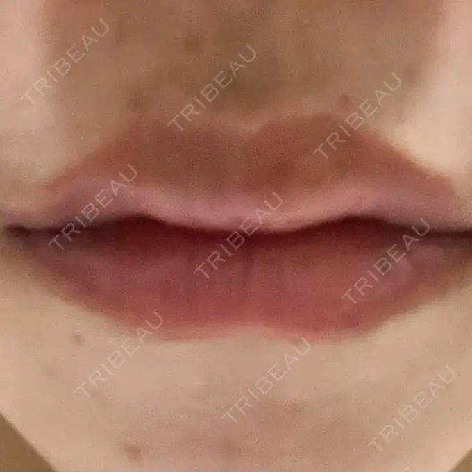 ヒアルロン酸注入（涙袋） / ヒアルロン酸注入（唇） / ヒアルロン酸注入（鼻翼基部） HAAB BEAUTY CLINIC 名古屋院 AFTER メイン用