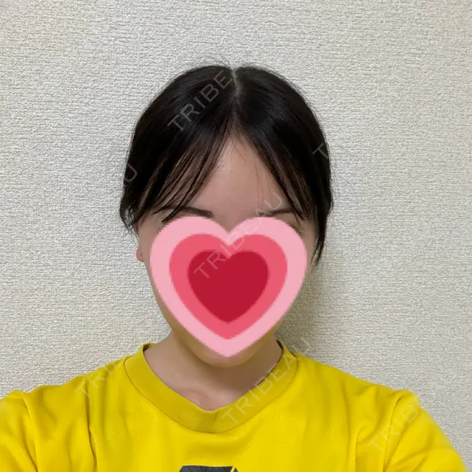 糸リフト / 脂肪吸引（顔） / ボトックス（エラ・小顔） RIVER CLINIC（リバークリニック） DAY 4 メイン用