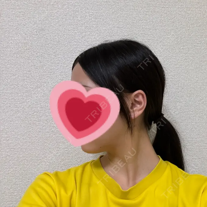 糸リフト / 脂肪吸引（顔） / ボトックス（エラ・小顔） RIVER CLINIC（リバークリニック） DAY 4 メイン用