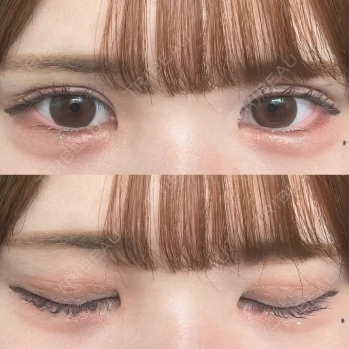 二重埋没 / 上まぶたの脂肪取り THE FIRST CLINIC 多摩センター院 DAY 5 メイン用