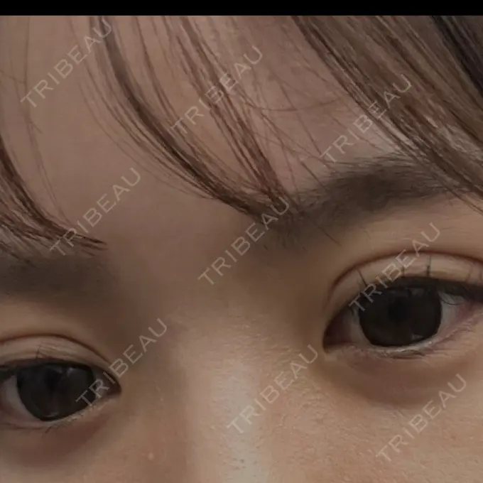 二重埋没 アリエル美容クリニック 郡山院 DAY 1 メイン用