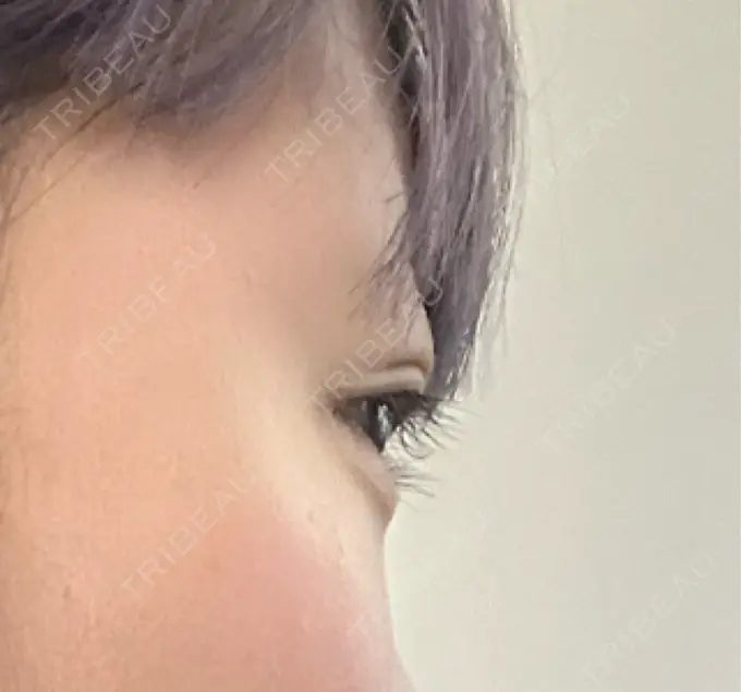 ヒアルロン酸注入（涙袋） / ボトックス（エラ・小顔） TCB東京中央美容外科 熊本院 DAY 0 メイン用