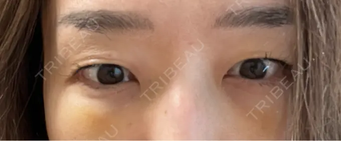 クマ治療 セオリークリニック DAY 4 メイン用