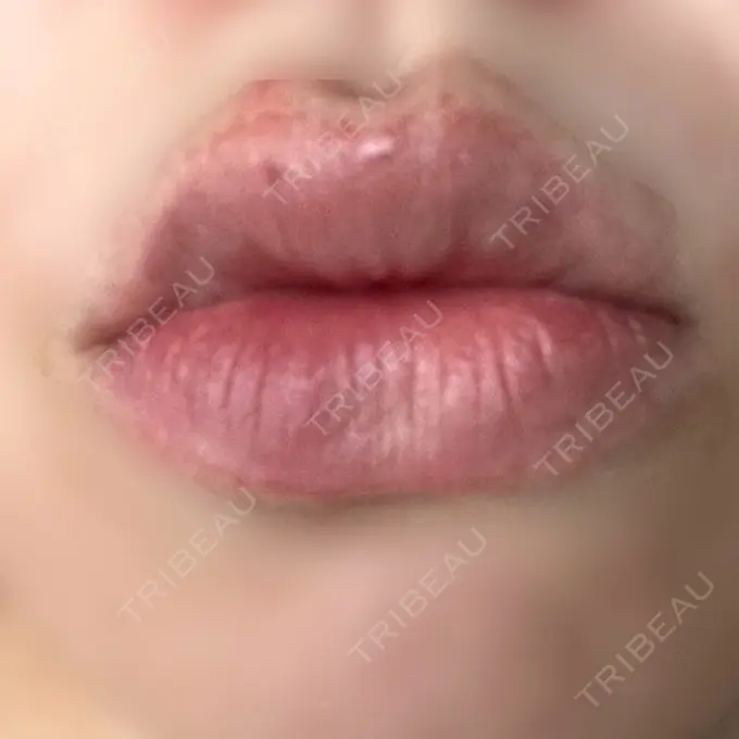 ヒアルロン酸注入（唇） ルラ美容クリニック 名古屋栄院 / ルラスキンクリニック 名古屋栄院 DAY 9 メイン用