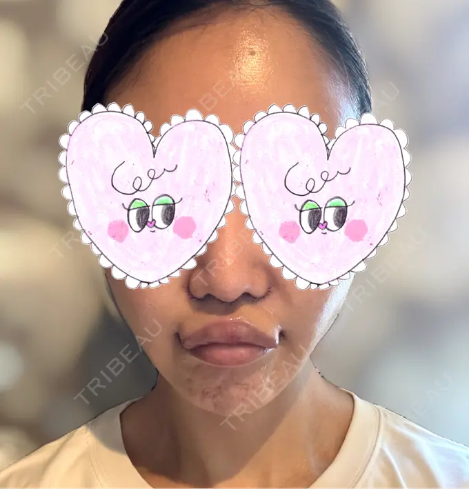 人中短縮 / 口角挙上 Otus Clinic 【オータスクリニック】 DAY 10 メイン用