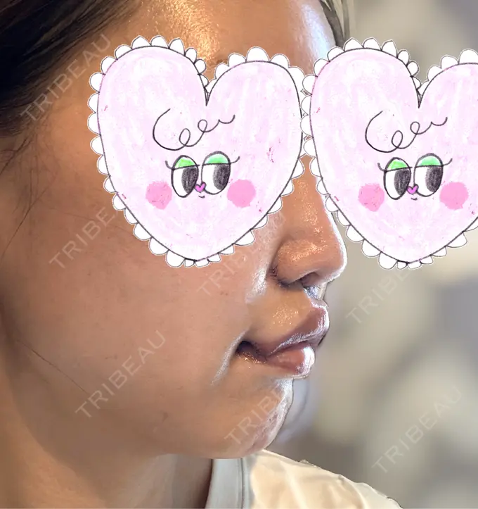 人中短縮 / 口角挙上 Otus Clinic 【オータスクリニック】 DAY 10 メイン用