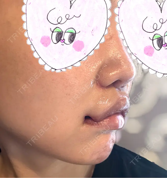 人中短縮 / 口角挙上 Otus Clinic 【オータスクリニック】 DAY 11 メイン用