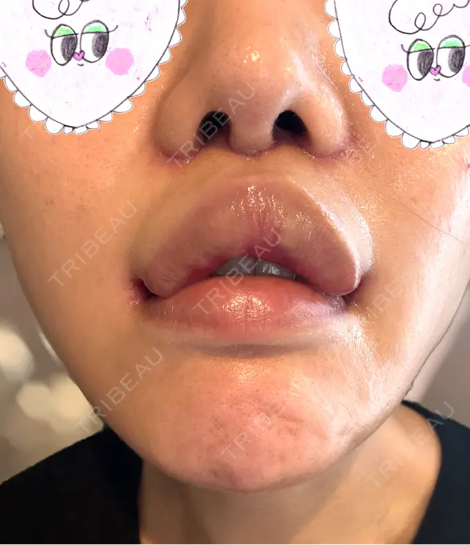 人中短縮 / 口角挙上 Otus Clinic 【オータスクリニック】 DAY 11 メイン用