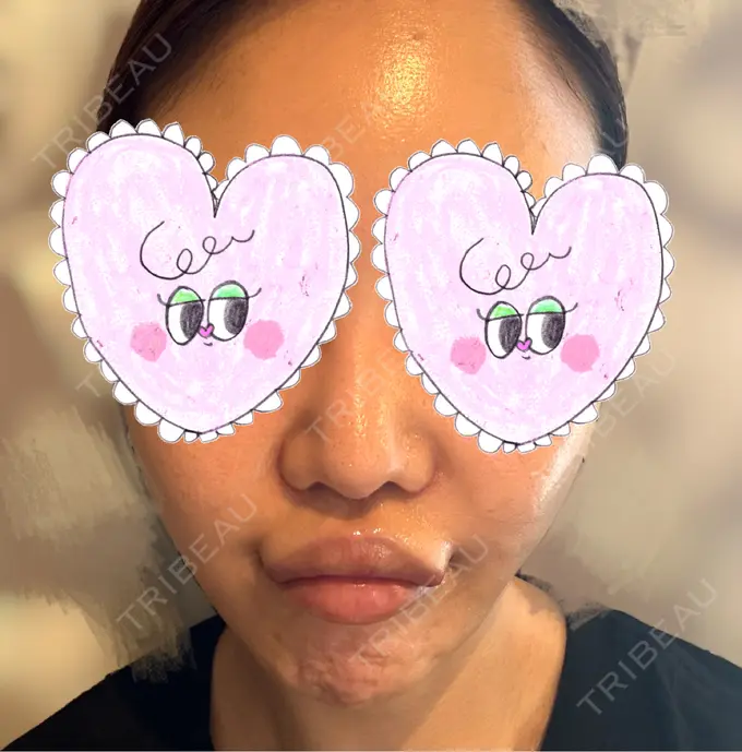 人中短縮 / 口角挙上 Otus Clinic 【オータスクリニック】 DAY 11 メイン用