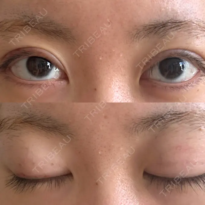 二重埋没 東京ココセランクリニック DAY 17 メイン用