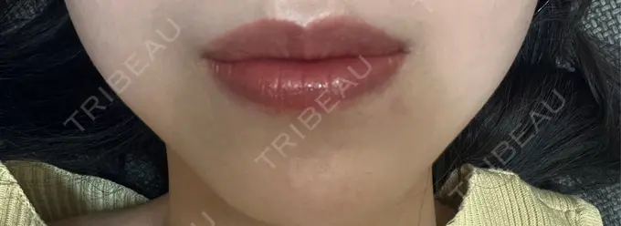 ボトックス（あご） ルラ美容クリニック 名古屋本院 DAY 5 メイン用