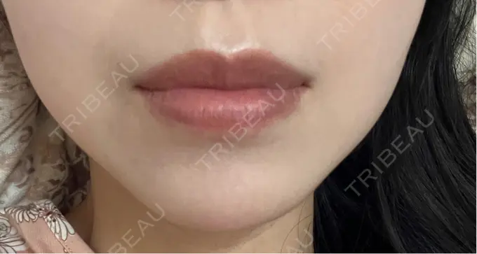 ボトックス（あご） ルラ美容クリニック 名古屋本院 DAY 6 メイン用