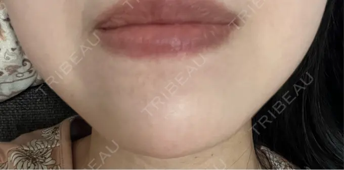 ボトックス（あご） ルラ美容クリニック 名古屋本院 DAY 7 メイン用