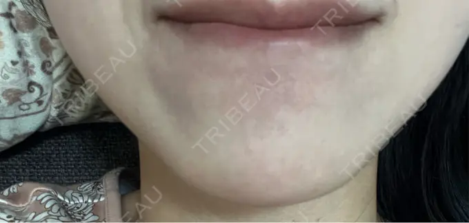 ボトックス（あご） ルラ美容クリニック 名古屋本院 DAY 8 メイン用