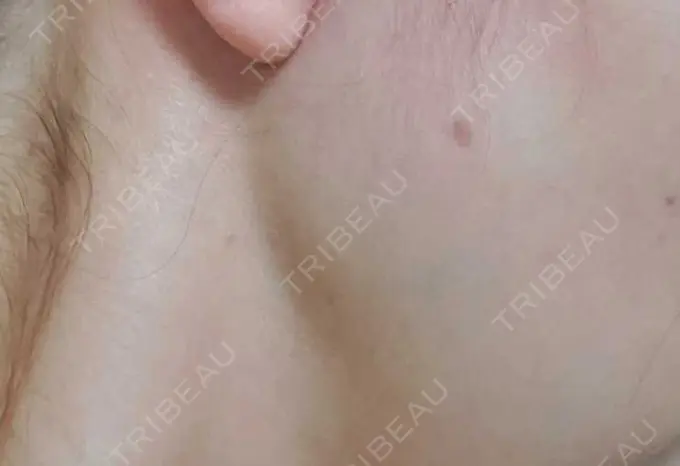 ほくろ・いぼ除去レーザー（肌） Mavie Beauty Clinic （マヴィービューティークリニック） DAY 64 メイン用