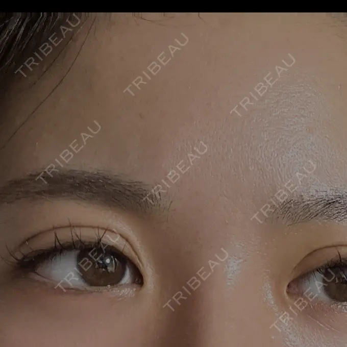 二重埋没 アリエル美容クリニック 郡山院 DAY 2 メイン用