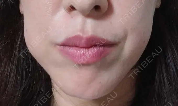 ボトックス（エラ・小顔） TCB東京中央美容外科 金山院 DAY 19 メイン用