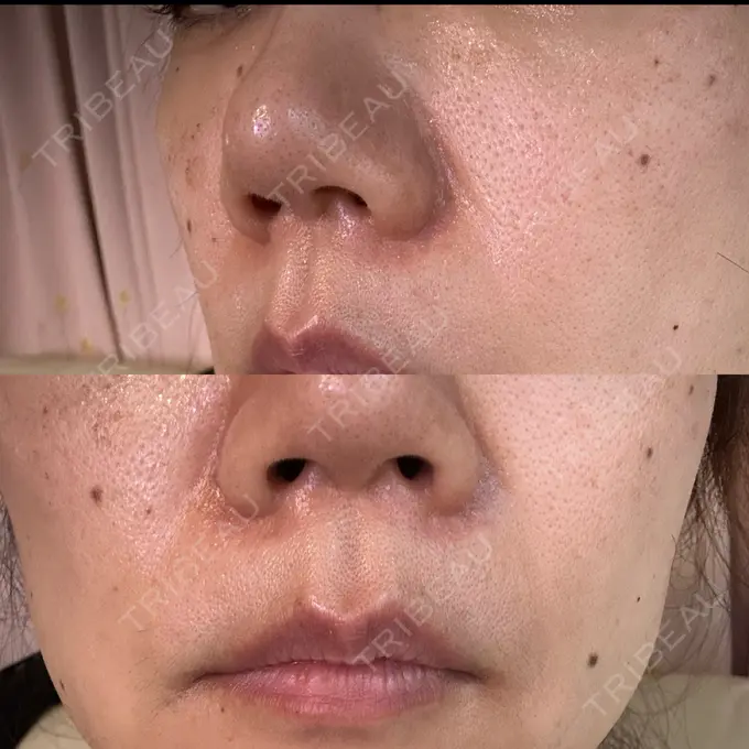 ボトックス（口角） / ルメッカ ルラ美容クリニック 渋谷本院 AFTER メイン用