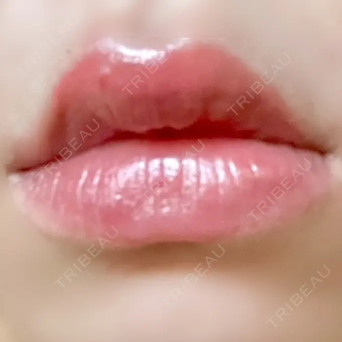 ヒアルロン酸注入（唇） ルラ美容クリニック 名古屋栄院 / ルラスキンクリニック 名古屋栄院 AFTER メイン用