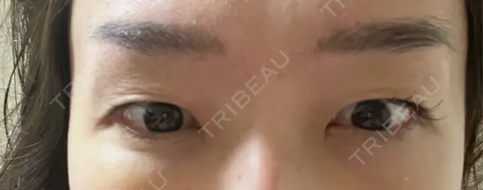 クマ治療 セオリークリニック DAY 6 メイン用