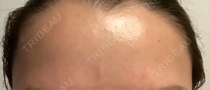 ボトックス（額） TCB東京中央美容外科 横浜駅前院 AFTER メイン用