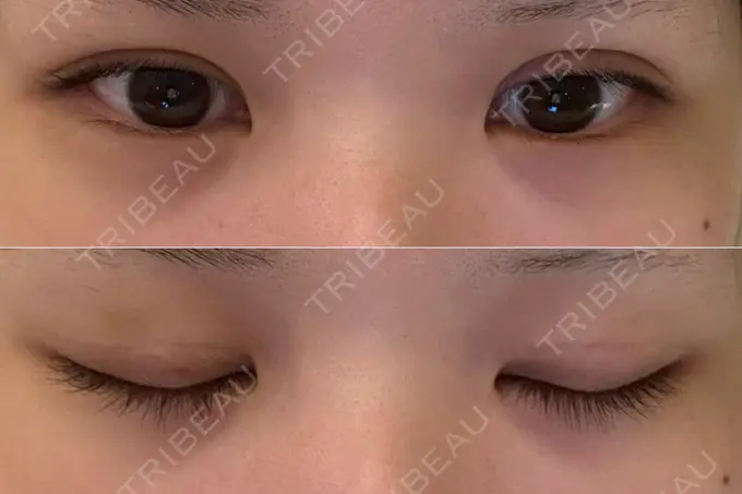 二重埋没 / 上まぶたの脂肪取り THE FIRST CLINIC 多摩センター院 DAY 7 メイン用