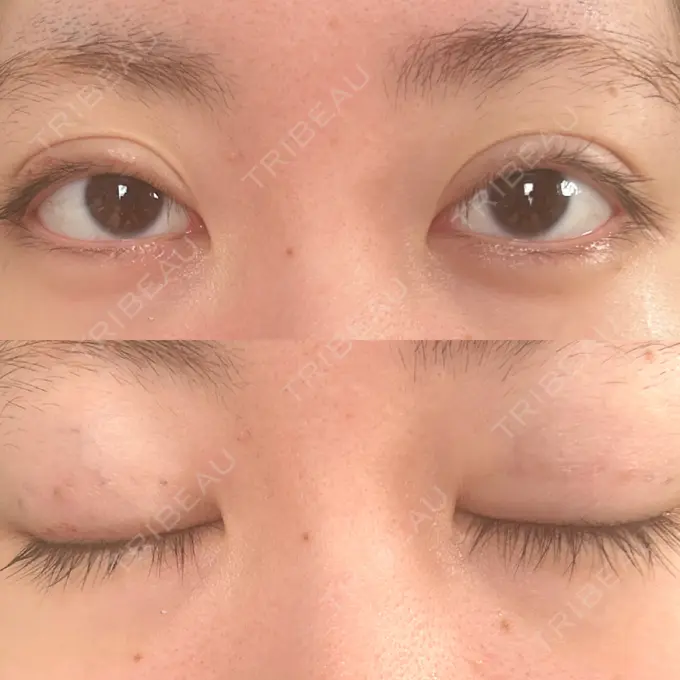 二重埋没 東京ココセランクリニック DAY 19 メイン用