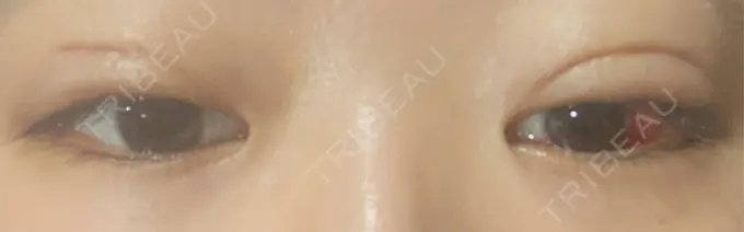 二重埋没 / 上まぶたの脂肪取り アリエル美容クリニック 郡山院 DAY 10 メイン用