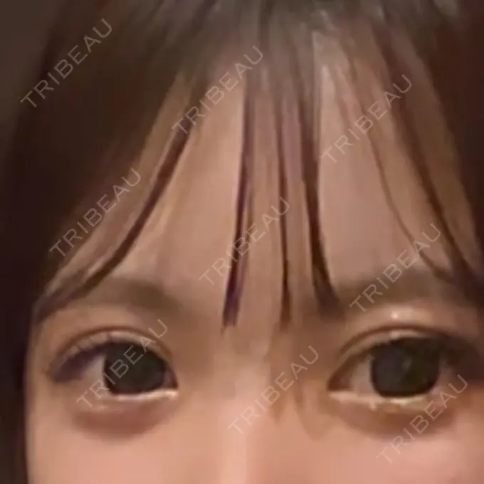 二重埋没 アリエル美容クリニック 郡山院 DAY 3 メイン用