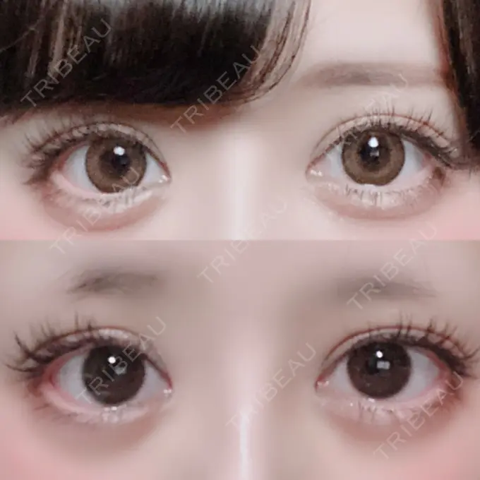 二重切開 / 目頭切開 / ヒアルロン酸注入（涙袋） FROM B整形外科 (旧バウム整形外科) AFTER メイン用