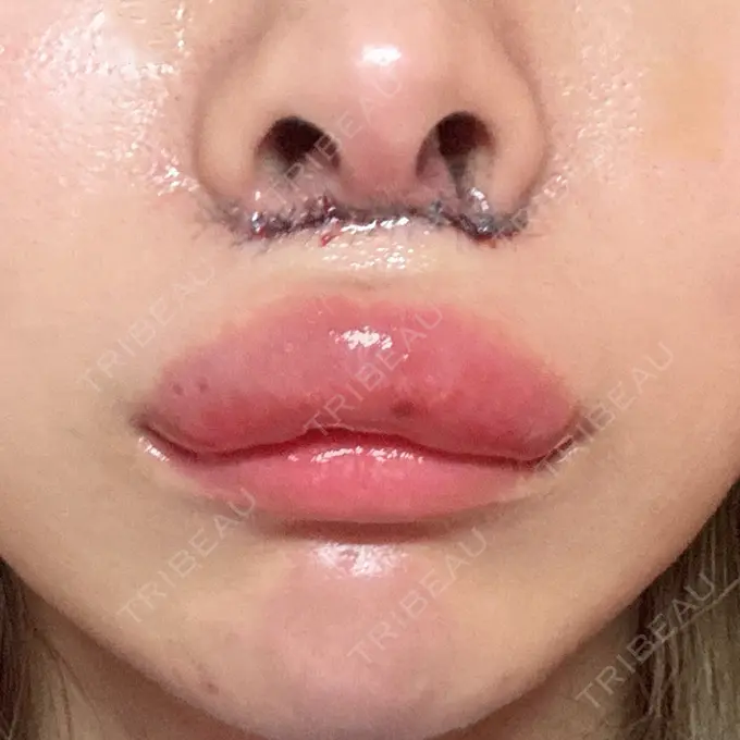 人中短縮 / 目尻切開 / ヒアルロン酸注入（鼻翼基部） 新宿ラクル美容外科クリニック 六本木院 DAY 1 メイン用