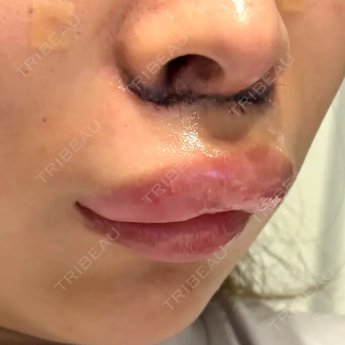 人中短縮 / 目尻切開 / ヒアルロン酸注入（鼻翼基部） 新宿ラクル美容外科クリニック 六本木院 DAY 2 メイン用