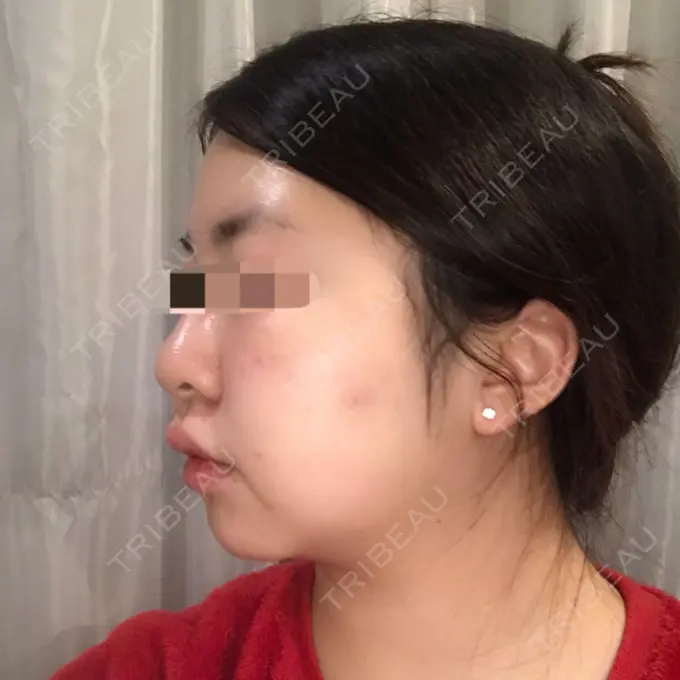 バッカルファット除去 / 脂肪吸引（顔） THE PLAN（ザ・プラン）美容整形外科・皮膚科 DAY 25 メイン用