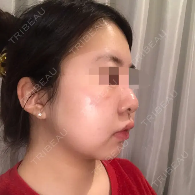 バッカルファット除去 / 脂肪吸引（顔） THE PLAN（ザ・プラン）美容整形外科・皮膚科 DAY 25 メイン用