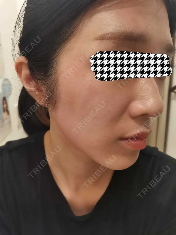 ルメッカ ルラ美容クリニック 高田馬場院 DAY 0 メイン用