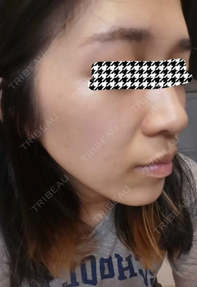 ルメッカ ルラ美容クリニック 高田馬場院 DAY 1 メイン用